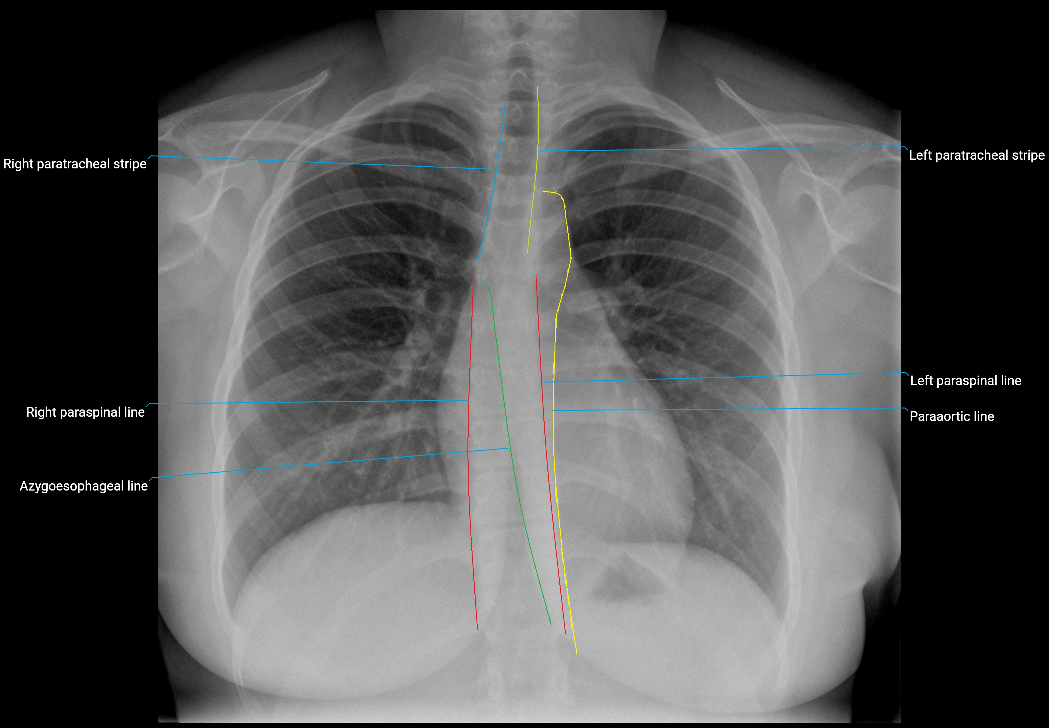 x ray CHEST PA lines.webp